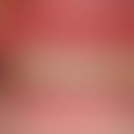 Lichen planus erosivus mucosae. painful gingivitis existing for more than one year. altogether pr...