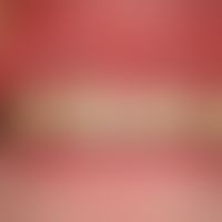 Lichen planus erosivus mucosae. Seit mehr als einem Jahr bestehende, schmerzhafte Gingivitis.Insg...