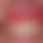 Lichen planus erosivus mucosae. painful gingivitis existing for more than one year in cases of cu...