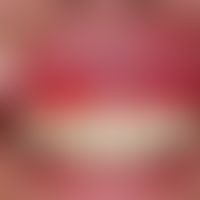 Lichen planus erosivus mucosae. painful gingivitis existing for more than one year in cases of cu...