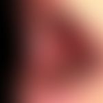 Lichen planus erosivus mucosae. extensive, painful erosive mucositis existing for more than one y...