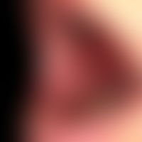 Lichen planus erosivus mucosae. extensive, painful erosive mucositis existing for more than one y...