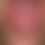 Lichen planus (erosivus) mucosae: multiple, chronically active (since about 1 year), extensive, p...