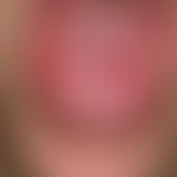 Lichen planus (erosivus) mucosae: multiple, chronically active (since about 1 year), extensive, p...