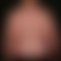 DD: Lipomatosis, benign symmetric: so-called truncal obesity after many years of treatment with s...