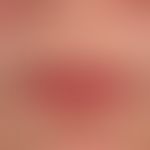 Atrophy, senile: age-related involution of the lip skin with radial furrow formation.
