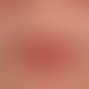 Perlèche: altersgerechte Involution der Lipppen. Deutliche Cheilitis actinica. Diskrete beidseiti...