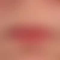 Perlèche: altersgerechte Involution der Lipppen. Deutliche Cheilitis actinica. Diskrete beidseiti...