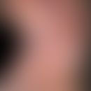 Leukämie akute myeloische: große rot-braune (hämorrhagische), unscharf begrenzte,&nbsp;oberfläche...