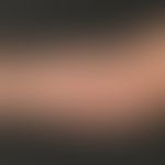 Lipoma: A subcutaneous lump on the upper arm which has existed for years, is completely unattract...