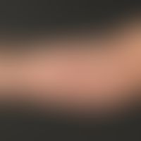 Lipoma: A subcutaneous lump on the upper arm which has existed for years, is completely unattract...
