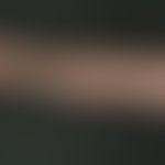 Lipomas: spherical soft painless tumours that have reached this size over a period of 3-4 years, ...
