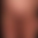 Sneddon-Syndrom: ausgedehnte bizarre Netzzeichnung in dern Haut. Akuter Schub mit multiplen kutan...