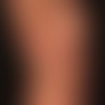 Sneddon-Syndrom: klinisches Bild der ausgedehnten Livedo racemosa mit den typischen nicht geschlo...