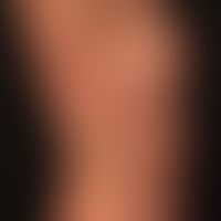 Sneddon-Syndrom: klinisches Bild der ausgedehnten Livedo racemosa mit den typischen nicht geschlo...