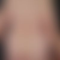 Sneddon-Syndrom: klinisches Bild einer ausgedehnten, ortskonstanten&nbsp;Livedo racemosa mit den ...