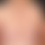 Sneddon-Syndrom: klinisches Bild der ausgedehnten Livedo racemosa mit den typischen nicht geschlo...