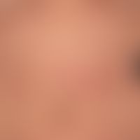 Differenzialdiganose: Livedo reticularis

Diagnose: Livedo racemosa: nachgezeichnet die bizarren ...