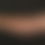 Livedo reticularis: funktionelles temperaturabhängiges Livedobild mit geschlossenen Ringstrukture...