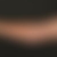 Livedo reticularis: funktionelles temperaturabhängiges Livedobild mit geschlossenen Ringstrukture...
