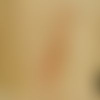 Porokeratosis linearis unilateralis: For years, a site-constant linear dermatosis with non-itchin...