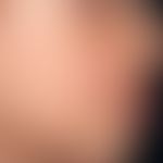 Naevus verrucosus:&nbsp;bereits bei Geburt vorhandene, bizarr verwirbelte, lineare und flächige,&...