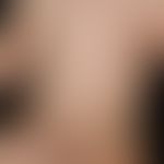 Naevus verrucosus(Serie): Klinisches Bild mit&nbsp;17 Monaten
