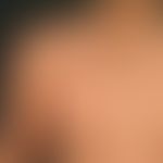 Naevus verrucosus unius lateralis mit warzenartigen Papeln und Plaques. Abrupte Begrenzug zur Mit...