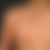 Naevus verrucosus unius lateralis with wart-like papules and plaques, abrupt limitation to the mi...