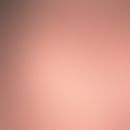 Naevus sebaceus (childhood): Congenital (but only noticeable with the onset of hair growth) hairl...