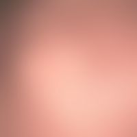 Naevus sebaceus (childhood): Congenital (but only noticeable with the onset of hair growth) hairl...