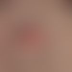 Naevus sebaceus: angeborene, zunächst unbemerkt gebliebene, höckerige, rote haarlose Stelle; seit...