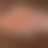 Naevus sebaceus: chronically inpatient, solitary, approx. 4.0 x 2.0 cm, sharply defined, oily shi...