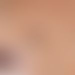 blue nevus. black shining through, sharply defined, clearly and evenly indurated node with unalte...
