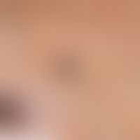blue nevus. black shining through, sharply defined, clearly and evenly indurated node with unalte...