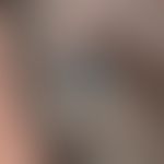 blue nevus. blue-black, coarse, sharply defined, calotte-shaped node with a smooth, like polished...