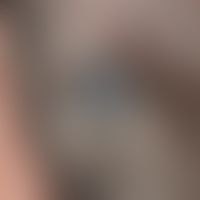 blue nevus. blue-black, coarse, sharply defined, calotte-shaped node with a smooth, like polished...