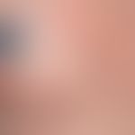 Blue naevus. blue-black shimmering through, sharply defined, clearly and evenly indurated knots w...