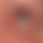 Naevus fuscocoeruleus ophthalmomaxillaris: blaugraue Verfärbung der Skleren (durch Pfeil markiert...