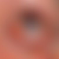 Naevus fuscocoeruleus ophthalmomaxillaris: blaugraue Verfärbung der Skleren (durch Pfeil markiert...