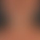 Diffuse, uniform, grey-black discolouration of the skin in a 52-year-old patient with metastatic ...