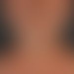 Melanose. Diffuse, gleichförmige, v.a. die gesamte Gesichtsfläche und Halspartien umfassende, gra...