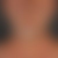 Melanose. Diffuse, gleichförmige, v.a. die gesamte Gesichtsfläche und Halspartien umfassende, gra...