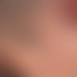 Melanom malignes (Übersicht):&nbsp; Seit Jahren bekannter kontinuierlich wachsender Knoten bei ei...
