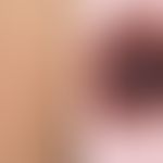 Melanom malignes (Übersicht): initiales maligne Melanom, bei Routineuntersuchung als Zufallsbefund.
