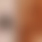 Melanom malignes "Typ SSM mit knotigem Anteil": fortgeschrittenes malignes Melanom vom Typ des ob...