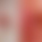 Melanom malignes (weitgehend amelanotisch): durch Abbau des Melanins nahezu pigmentfreier, sympto...