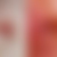Melanoma malignes (largely amelanotic): due to degradation of the melanin almost pigment-free, sy...