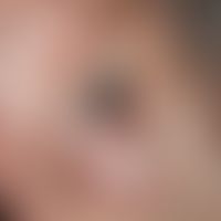 Lentigo-maligna-Melanom: seit mehreren Jahren bekannter, langsam wachsender, zunächst brauner, da...