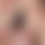 Lentigo-maligna-Melanom (Detailaufnahme): seit mehreren Jahren bekannter, langsam wachsender, zun...